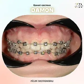 Ортодонт Дрогобич Zakhariia Dental Брекети — фото 4
