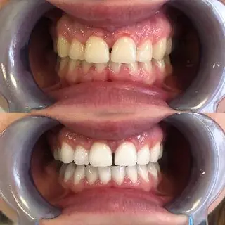 GI TEETH & FACE — фото