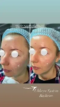 Смас ліфтинг Ulthera, контурна пластика, чистка обличчя Hydrafacial та фототерапія IPL у Renaissance Clinique — фото 5