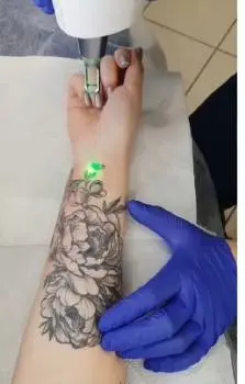 Tattoo Removal (in Adam Frank) — фото 2
