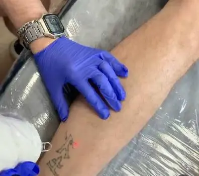 Tattoo Removal (in Adam Frank) — фото 5